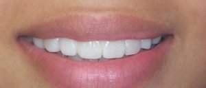 Snap-On Smile é indicado para pacientes que não querem ou não podem realizar os tratamentos convencionais, mas gostariam de melhorar a sua estética sem restabelecer sua função mastigatória imediatamente, pois é um tratamento não-invasivo, não havendo necessidade de preparos dentários e nem de procedimentos anestésicos.